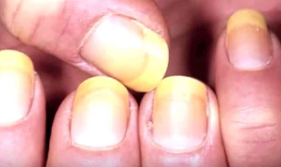 verfärbte-Nägel-gelb.jpg verfärbte Fingernägel