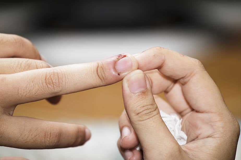 Nagelbettinfektion.jpg