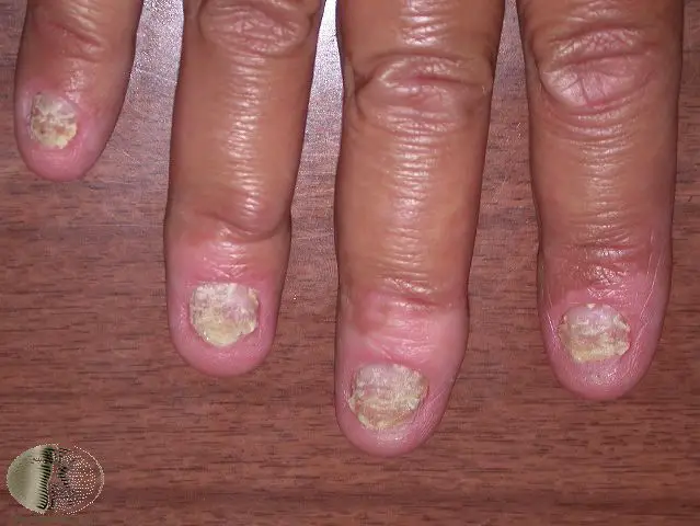 https://www.dermnetnz.org/topics/nail-psoriasis-images/