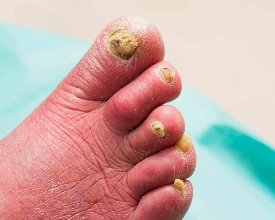 Nagelpilzbild-3.jpg Älterer Patient. Chronische Mykotische Infektion