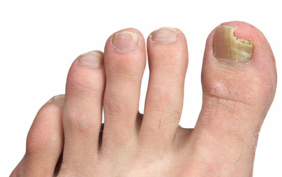Nagelpilzbild-8.jpg Befall der Nagelplatte mit bereits abbrechenden Tendenzen