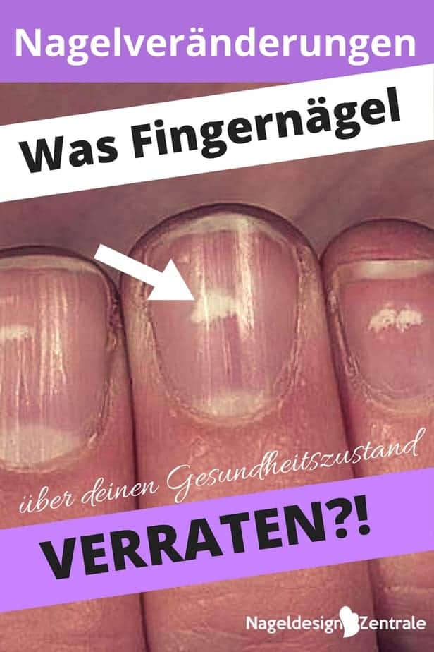 Wellen & Dellen im Fingernagel? Bei uns findet ihr einen informativen und umfassenden Artikel zu dem Thema, was Nagelveränderungen über deinen Gesundheitszustand aussagen können! Weiße Flecken im Nagel, Dellen, Wellen, Längsrillen, Verfärbungen? Die häufigsten Veränderungen erklären wir euch auf der Nageldesignzentrale.de LG Micha