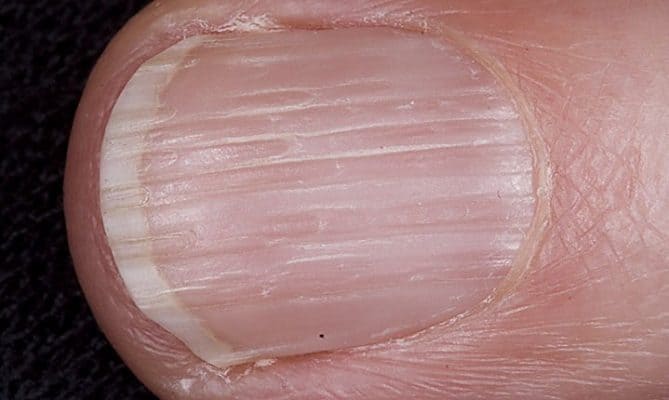Wellen und Dellen im Fingernagel: Was Fingernägel über deine Gesundheit