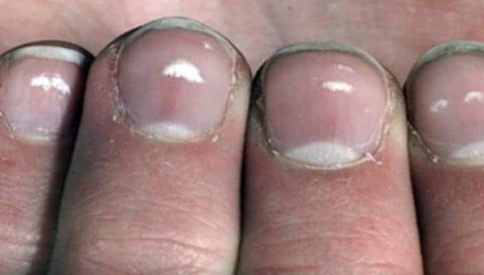 Nagelveränderung Weißnägel was bedeutet das? - Nageldesign Zentrale
