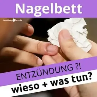 Nagelbettentzundung Symptome Und Warum Du Besser Zum Arzt Gehst Nageldesign Zentrale