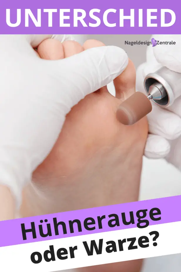 Hühnerauge oder Warze? Was ist der Unterschied – was hilft dagegen?
