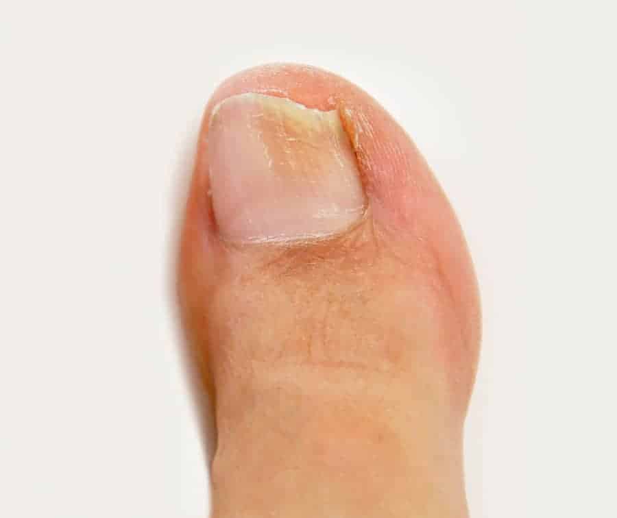 Wie kannst du Fußnagelpilz erkennen und behandeln (Bilder