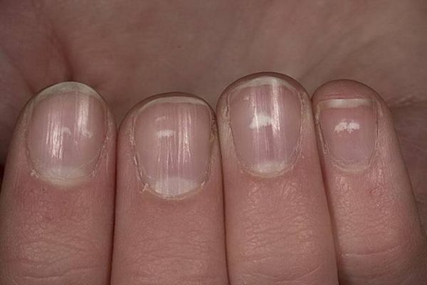 Wellen Und Dellen Im Fingernagel Was Fingern gel ber Deine Gesundheit Verraten Nageldesign 